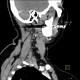 Inflammatory lymph node with liquefaction: CT - Computed tomography